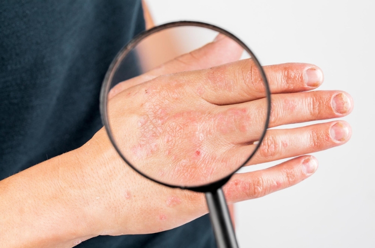Dermatology,Pranaah Hospital, Dr. B. Vinay Kumar
