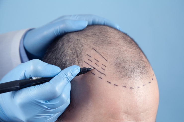 Hair Transplant Surgeries,Pranaah Hospital, Dr. B. Vinay Kumar
